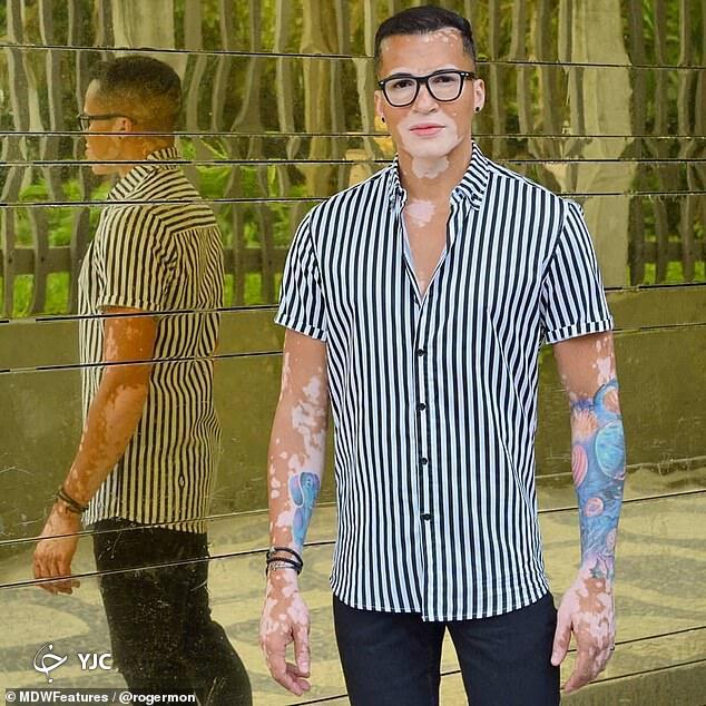 عارضه پوستی ای که مدل برزیلی را به افسردگی شدید کشاند