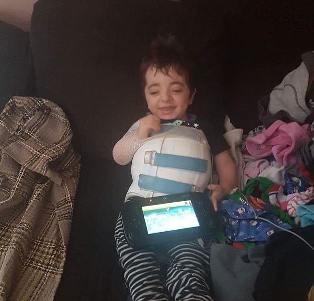 کودکی که دچار ۵۰۰ بار شکستگی اعضای بدن شده است + تصاویر