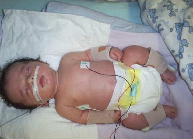 کودکی که دچار ۵۰۰ بار شکستگی اعضای بدن شده است + تصاویر