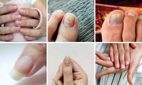 ۷ علامت هشداردهنده کلسترول بالا در ناخن کدامند؟