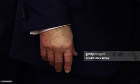 تصویری از دست گریم شده ترامپ در نشست خبری امروز در کاخ سفید