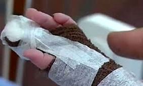 قطع انگشت نوزاد ۹/۵ ماهه‌ی زنجانی با قیچی