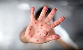 سرخک در اصفهان شناسایی نشده است