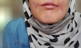 مرد بی‌رحم لب‌های زن ۱۸ ساله‌اش را دوخت/ فائزه به کلانتری پناه برد