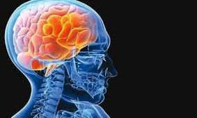 پیشگیری از سکته مغزی با ساده ترین راهکارها