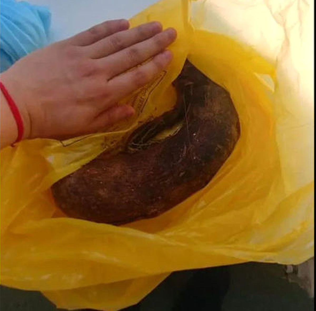خارج کردن توده مو از شکم دختر 19 ساله
