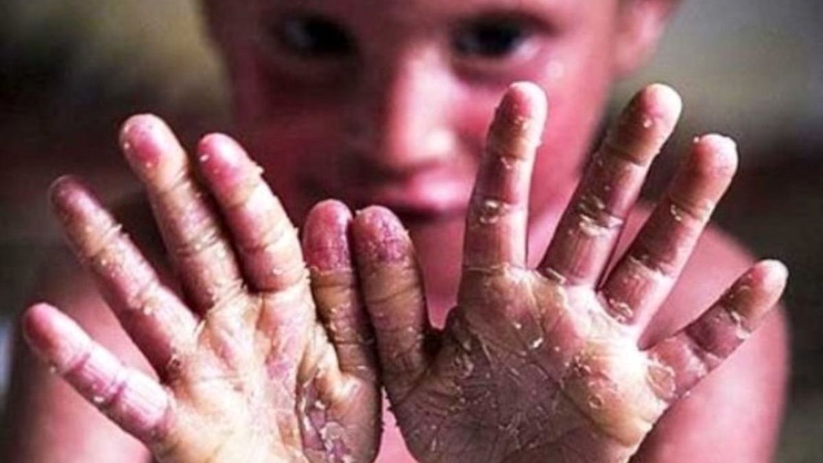 تجمع خانواده‌های کودکان "پروانه‌ای"