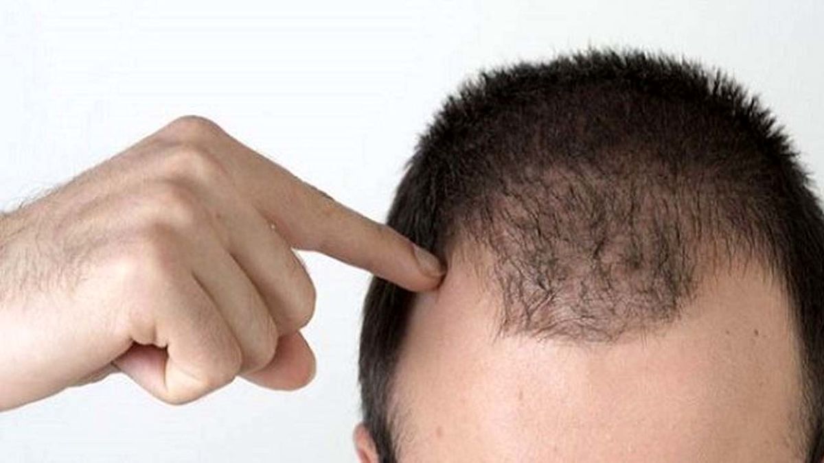هرآن‌چه آقایان باید از ریزش مو بدانند