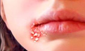 زرد زخم یا ایمپتیگو چیست؟