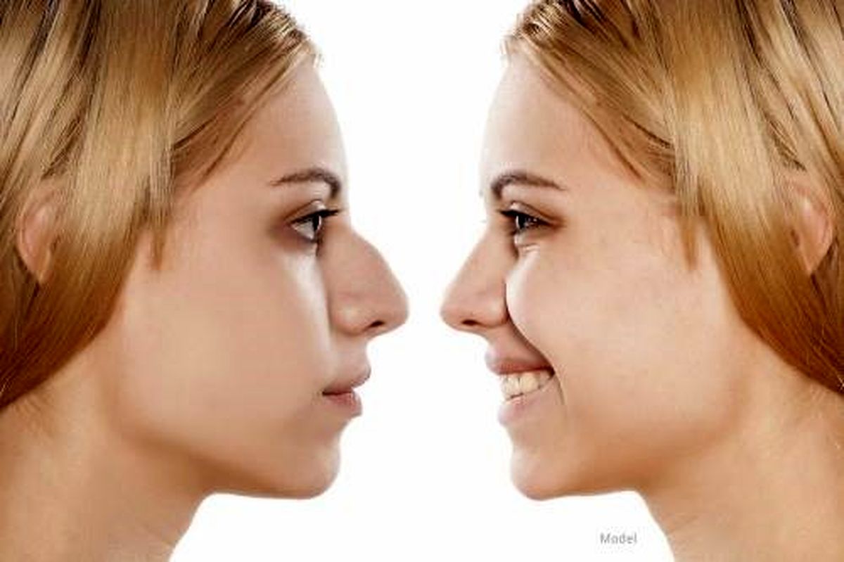 آشنایی با خطرات و عوارض عمل بینی