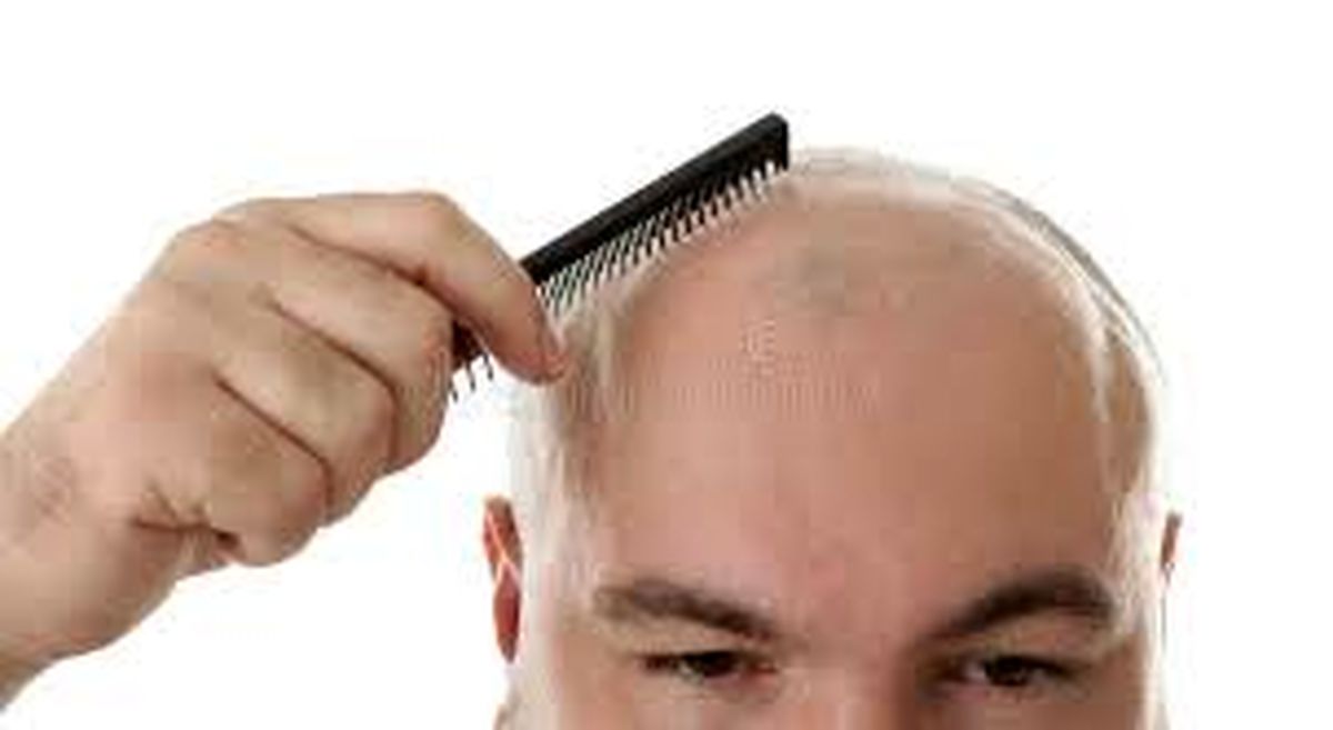 ریزش مو نشانه کدام بیماری است؟