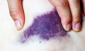 بدن ما چرا بی دلیل کبود می شود؟