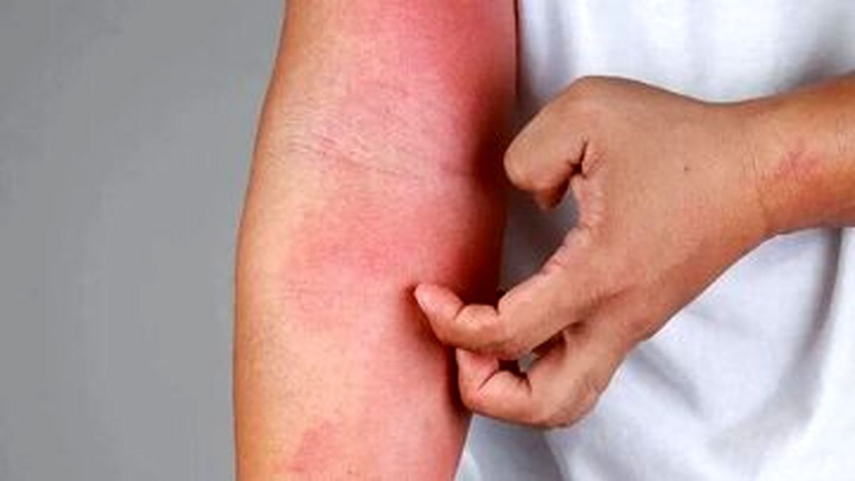 چگونه از شر خارش و التهاب در فصل بهار رها شویم؟