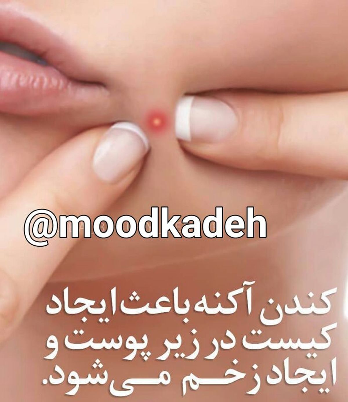 این نوع جوش ها را هرگز نترکانید!