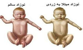 زردی نوزاد یا ایکتر چیست؟ + روش درمان زردی