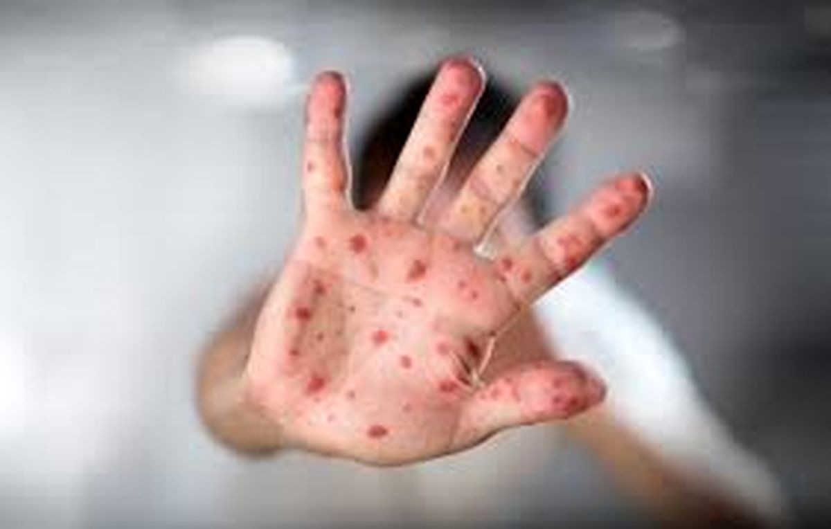 شیوع سه برابری سرخک