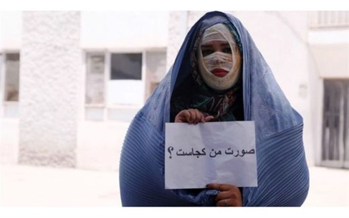 صورت‌های سوخته، امیدهای تازه/ گفت‌وگو با ۲ قربانی اسیدپاشی