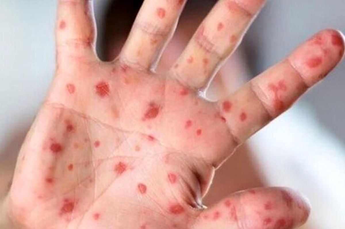 شناسایی یک کودک ۹ ماهه مبتلا به سرخک در قم