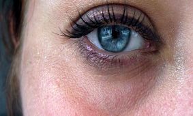 روش از بین بردن حلقه های تیره زیر چشم