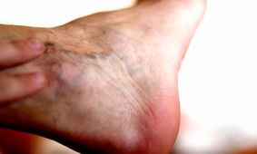 شاغلان در معرض ابتلا به واریس