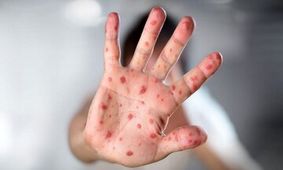 موردی از ابتلا به سرخک در قشم گزارش نشده است