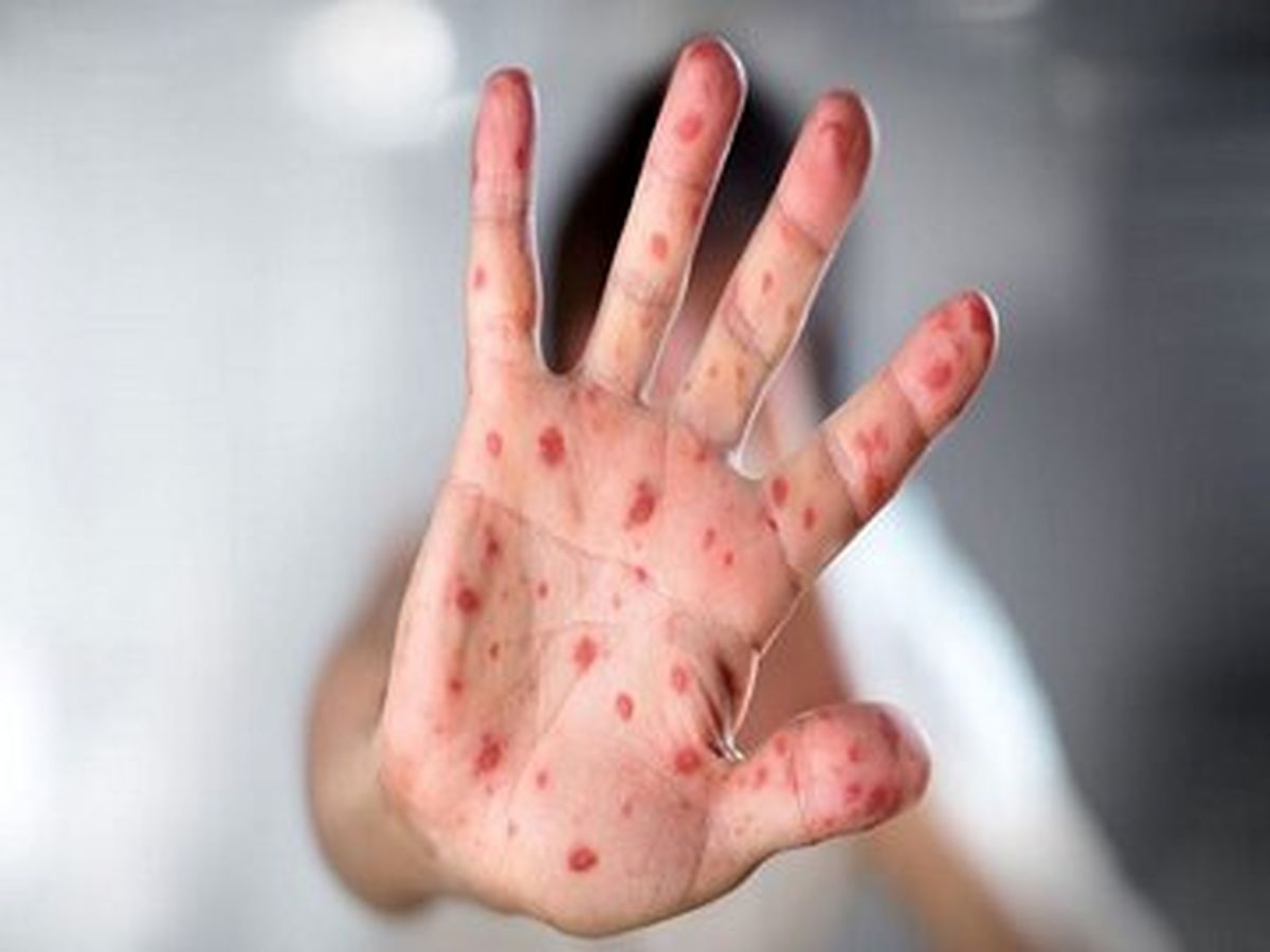 موردی از ابتلا به سرخک در قشم گزارش نشده است